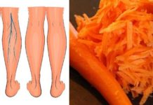 ახლა გიამბობთ როგორ განვიკურნე ჩემი მეზობლის დახმარებით ვარიკოზული ვენებისგან