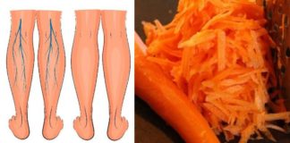 ახლა გიამბობთ როგორ განვიკურნე ჩემი მეზობლის დახმარებით ვარიკოზული ვენებისგან