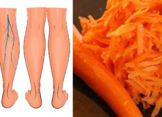 ახლა გიამბობთ როგორ განვიკურნე ჩემი მეზობლის დახმარებით  ვარიკოზული ვენებისგან