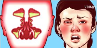 თუ არ იცით როგორ უმკურნალოთ სურდოს, გასწავლით ყველაზე სწრაფ და ეფექტურ მეთოდებს