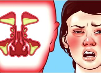 თუ არ იცით როგორ უმკურნალოთ სურდოს, გასწავლით ყველაზე სწრაფ და ეფექტურ მეთოდებს