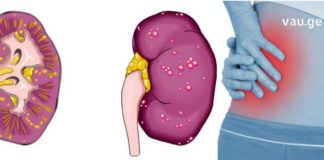 პიელონფრიტის მკურნალობა სახლის პირობებში საუკეთესო რეცეპტით