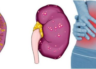 პიელონფრიტის მკურნალობა სახლის პირობებში საუკეთესო რეცეპტით