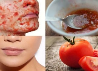 თუ გამონაყარი გაწუხებთ, ამ პრობლემას პომიდორი მოგიგვარებთ