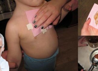 გასაოცარი კომპრესის რეცეპტი, რომელიც პირველივე ცდაზე აჩერებს ხველას