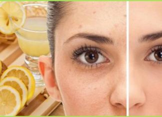 საუკეთესო ხალხური რეცეპტები ჭორფლის წინააღმდეგ.