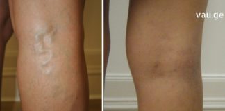 გასაოცარი წამალი ვენებისთვის