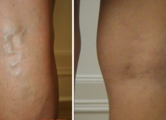 გასაოცარი წამალი ვენებისთვის