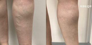 თუ ვენები გაწუხებთ, გასწავლით შესანიშნავ ხალხურ მეთოდებს, რომლებიც საკუთარ თავზე მაქვს გამოცდილი