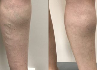 თუ ვენები გაწუხებთ, გასწავლით შესანიშნავ ხალხურ მეთოდებს, რომლებიც საკუთარ თავზე მაქვს გამოცდილი