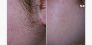 ჭარბთმიანობას დიდი ხნის განმავლობაში ვებრძოდი. ამ მეთოდებით მოვახერხე ზედმეტი თმების მოცილება უმტკივნეულოდ.