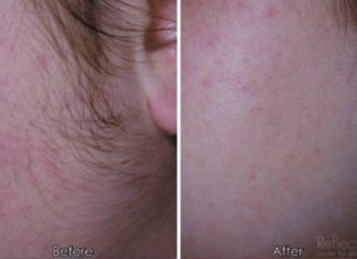 ჭარბთმიანობას დიდი ხნის განმავლობაში ვებრძოდი. ამ მეთოდებით მოვახერხე ზედმეტი თმების მოცილება უმტკივნეულოდ.