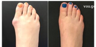 ნიკრისის ქარს ამ მეთოდებით დაამარცხებთ