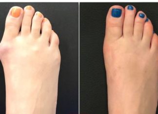 ნიკრისის ქარს ამ მეთოდებით დაამარცხებთ