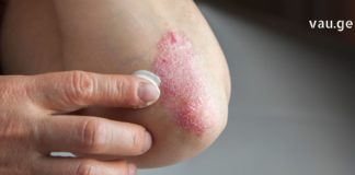 ფსორიაზის მკურნალობის საუკეთესო რეცეპტები ხალხური მედიცინისგან