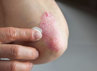 ფსორიაზის მკურნალობის საუკეთესო რეცეპტები ხალხური მედიცინისგან