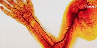 რა უნდა მოვიმოქმედოთ როცა ხელის არტერიების შევიწროვება გვაქვს?!