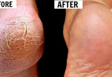 ქუსლების დასკდომის დროს ეს უებარი ხალხური მეთოდები დაგეხმარებათ