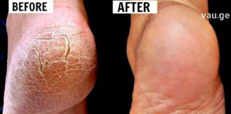 ქუსლების დასკდომის დროს ეს უებარი ხალხური მეთოდები დაგეხმარებათ