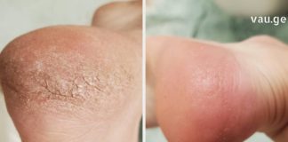 თუ ქუსლები დაგისკდათ, გაგიზიარებთ უებარ საშუალებებს, რომლებიც ხალხური მედიცინის წიგნში აღმოვაჩინე