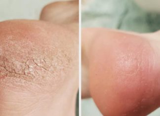 თუ ქუსლები დაგისკდათ, გაგიზიარებთ უებარ საშუალებებს, რომლებიც ხალხური მედიცინის წიგნში აღმოვაჩინე