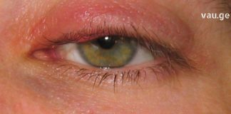 თუ თვალის ანთება გაქვთ, ან უბრალოდ დისკომფორტი გაქვთ თვალებში გახელისას და გიწითლდებათ, , გასწავლით საოცრად ეფექტურ რეცეფტებს