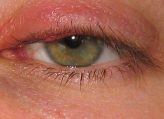 თუ თვალის ანთება გაქვთ, ან უბრალოდ დისკომფორტი გაქვთ თვალებში გახელისას და გიწითლდებათ, , გასწავლით საოცრად ეფექტურ რეცეფტებს