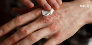 თუ ხელის კანი გისკდებათ და გიუხეშდებათ, გასწავლით უებარ რეცეპტს