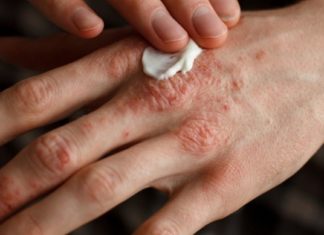 თუ ხელის კანი გისკდებათ და გიუხეშდებათ, გასწავლით უებარ რეცეპტს