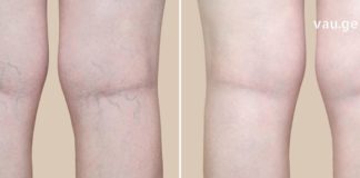 უკვე შუა ხანს მივაღწიე და ძალიან შემაწუხა ვენებმა. გაგიზიარებთ ჩემს მეთოდს როგორ ვმკურნალობ გაგანიერებულ ვენებს