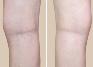 უკვე შუა ხანს მივაღწიე და ძალიან შემაწუხა ვენებმა. გაგიზიარებთ ჩემს მეთოდს როგორ ვმკურნალობ გაგანიერებულ ვენებს