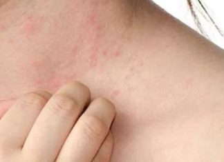 ჩემი და ალერგიული იყო ყველაფერსზე, სადაც კი წავიდოთ , ყველგან აცემინებდა, აყრიდა და ყველა ვდარდობით. ბოლოს როგორც იქნა საშველს მივაგენით