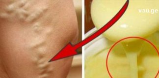 სახლში დამზადბული მალამო ვარიკოზული ვენებისთვის, რომელმაც დედაჩემი გადაარჩინა ოპერაციისგან