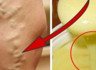 სახლში დამზადბული მალამო ვარიკოზული ვენებისთვის, რომელმაც დედაჩემი გადაარჩინა ოპერაციისგან