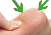 თუ თქვენ კოჟრები გაქვთ ჭინჭრის ფესვები დაგეხმარებათ