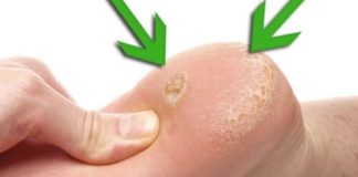 თუ თქვენ კოჟრები გაქვთ ჭინჭრის ფესვები დაგეხმარებათ