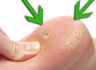 თუ თქვენ კოჟრები გაქვთ ჭინჭრის ფესვები დაგეხმარებათ