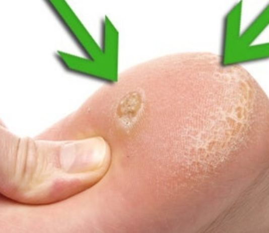 თუ თქვენ კოჟრები გაქვთ ჭინჭრის ფესვები დაგეხმარებათ