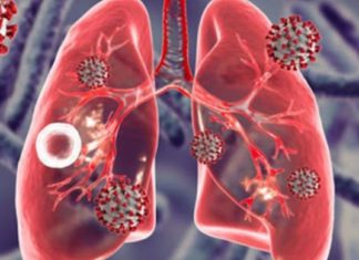 როგორ დავამარცხოთ ფილტვების ტუბერკულოზი?