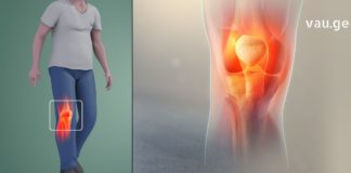 მუხლების ტკივილი გტანჯავთ? გაგიზიარებთ მრავალჯერ წარმატებით ნაცად რეცეპტს