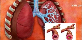 როგორ ვმართოთ ბრონქული ასთმა სახლის პირობებში?