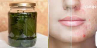 თუ გარდატეხის ასაკის გამონაყარი გტანჯავთ, გაგიზიარებთ შოკისმომგვრელ მეთოდს