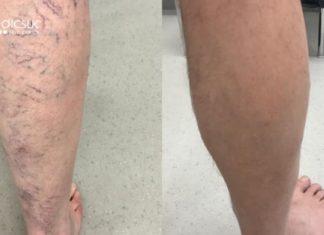 მოამზადეთ ტირიფის აბაზანები და სამუდამოდ დაივიწყეთ ვარიკოზი, რევმატიზმი და ართრიტი