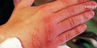 ნახეთ რა უნდა მოიმოქმედოთ დამწვრობის დროს