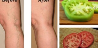 ხალხური საშაულებები ვენების ვარიკოზული გაგანიერების დროს