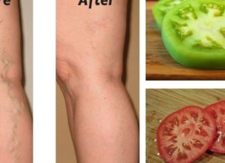 ხალხური საშაულებები ვენების ვარიკოზული გაგანიერების დროს