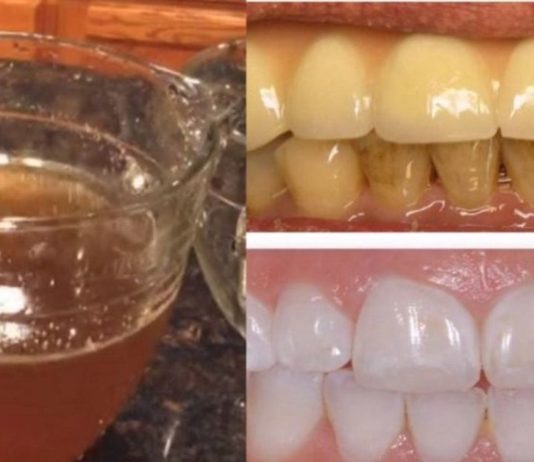 თუ გსურთ კარგი ჯანსაღი კბილები, თქვენ უნდა მოამზდოთ ეს ჩაი