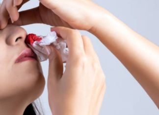 აი რა უნდა იცოდეთ ცხვირიდან სისხლდენის დროს