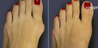 ამ ნაყენს დღემდე ვემადლიერები – დიდი ხანია დამავიწყდა როგორია პოდაგრით გამოწვეული ტკივილი