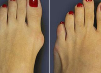 ამ ნაყენს დღემდე ვემადლიერები – დიდი ხანია დამავიწყდა როგორია პოდაგრით გამოწვეული ტკივილი